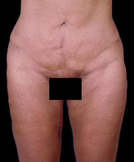 Front View Tummy Tuck After