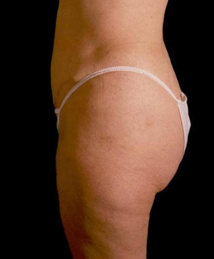 Stomach Lipo & Tummy Tuck Side View After