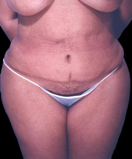 Female Tummy Tuck Surgery After