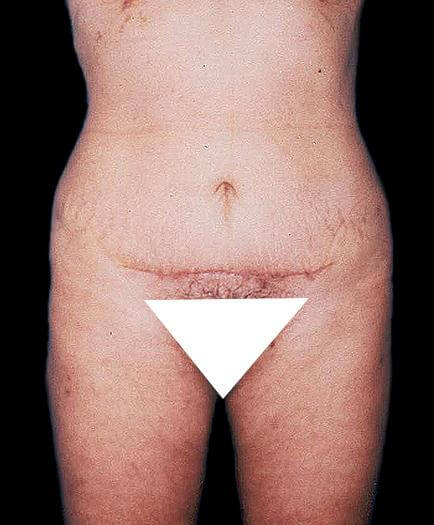 Mini Tummy Tuck After