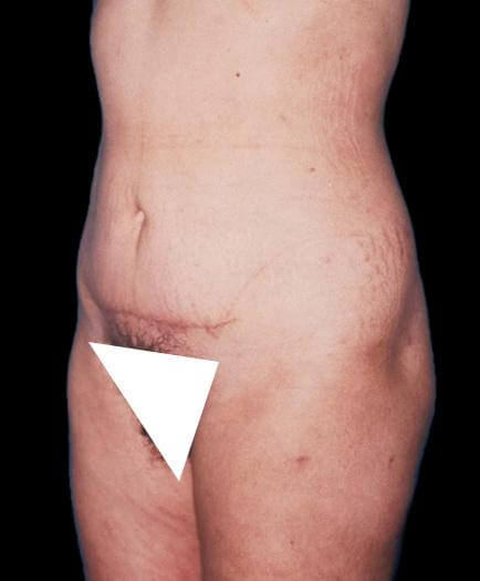 Mini Tummy Tuck Surgery After