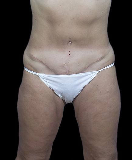 Stomach Abdominoplasty After