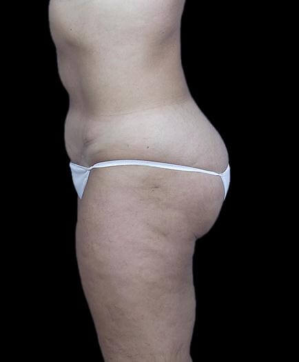 Stomach Abdominoplasty Side View After