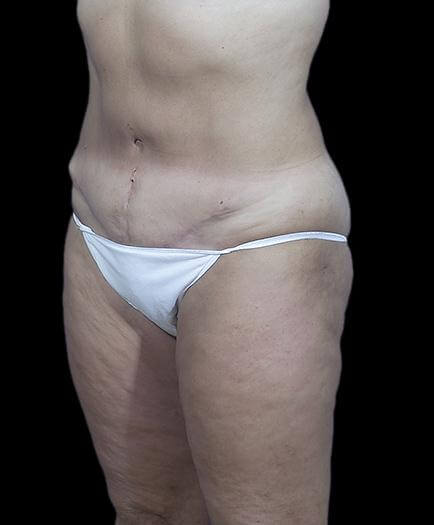 Stomach Abdominoplasty Quarter View After