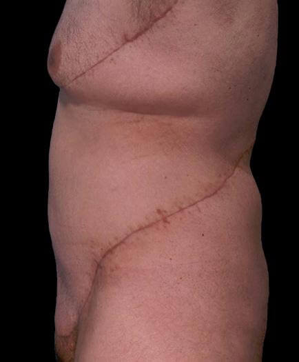 Male Tummy Tuck Side View After 