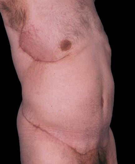 Male Tummy Tuck Quarter View After 