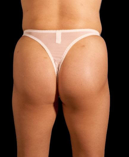 Buttock Augmentation Back View Before