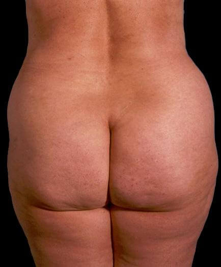 Buttock Contouring After