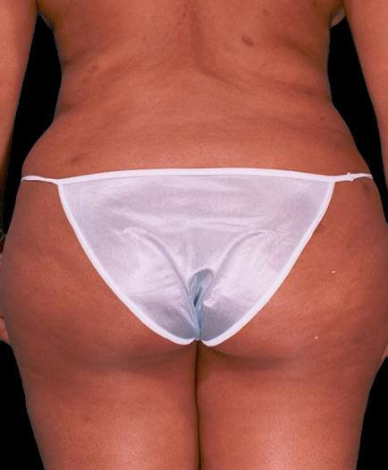 Buttock Enhancement After