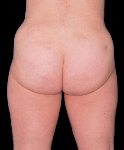 Buttock Liposuction After