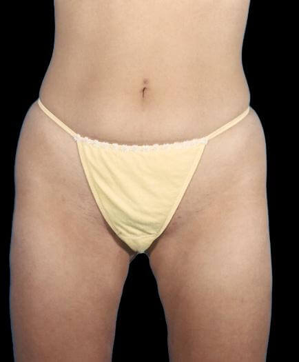 Female Lipo After