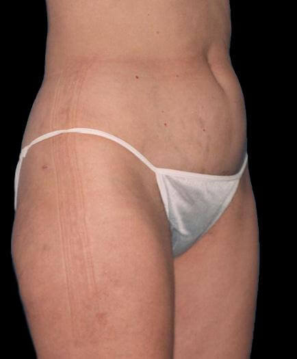 Liposuction Surgery After