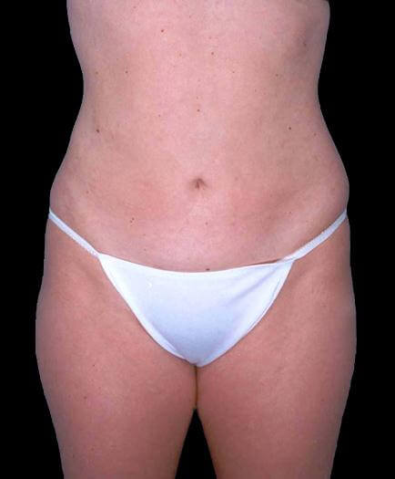 Female Liposuction Before 