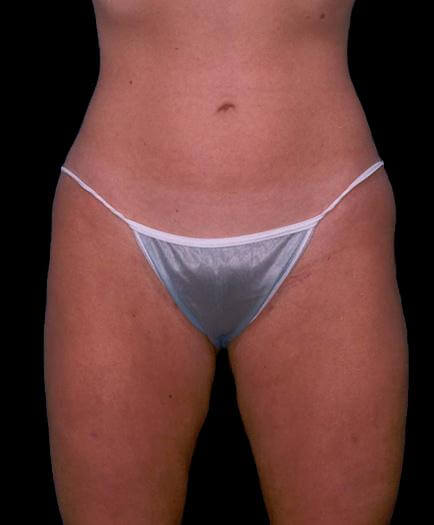 Thigh Liposuction After