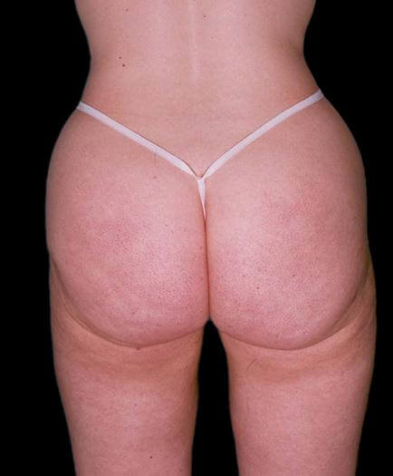 Thigh Lipo Surgery Back View After