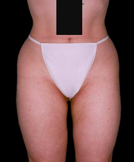 Thigh Lipo Surgery Front View After