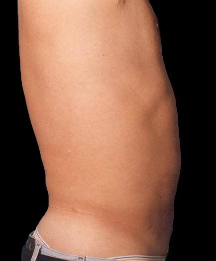 Male Lipo After