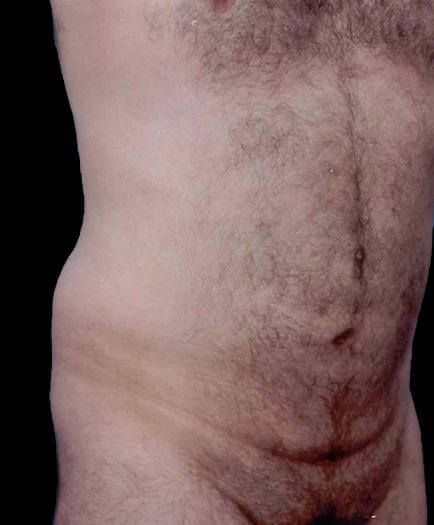 Liposuction For Men After