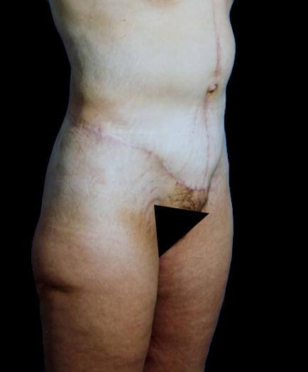 Post Bariatric Surgery After