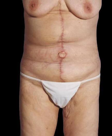 Belt Lipectomy After