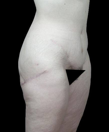 Thigh Lift Surgery After