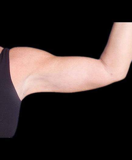 Arm Lift Plastic Surgery After