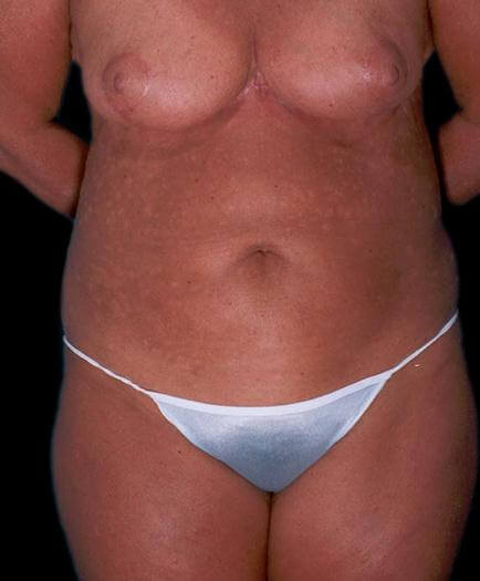 Tummy Tuck With Breast Reduction After