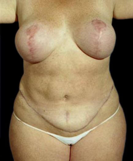 Body Contouring & Breast Reduction Front View After