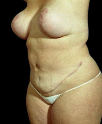 Body Contouring & Breast Reduction After