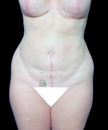 Breast Augmentation & Abdominoplasty After