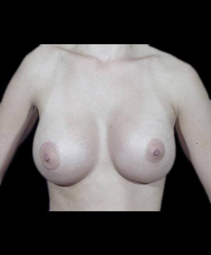 Breast Enlargement & Nipple Surgery After