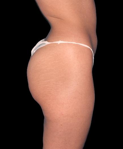Buttock Augmentation Side View Before