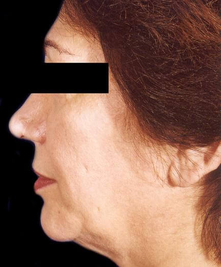 Before Facelift Surgery