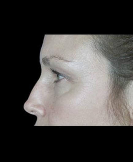 Before Eyelid Surgery Side View