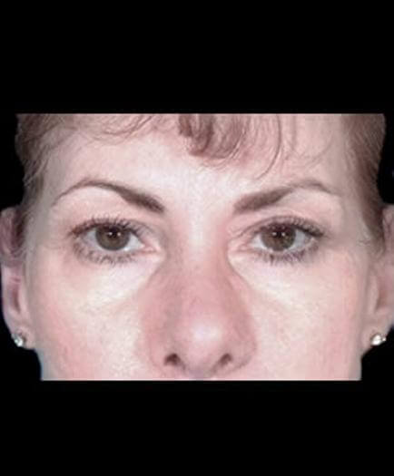 Eyelid Surgery Before