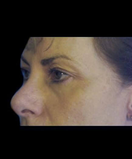 Before Blepharoplasty