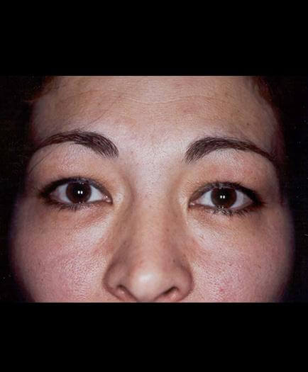 Blepharoplasty Surgery Before