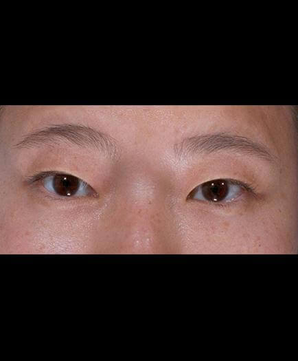 Eyelid Surgery Results