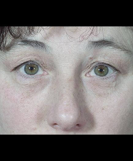 Before Virginia Eyelid Surgery