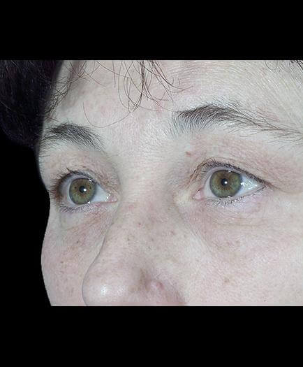 Before Blepharoplasty Left Side View