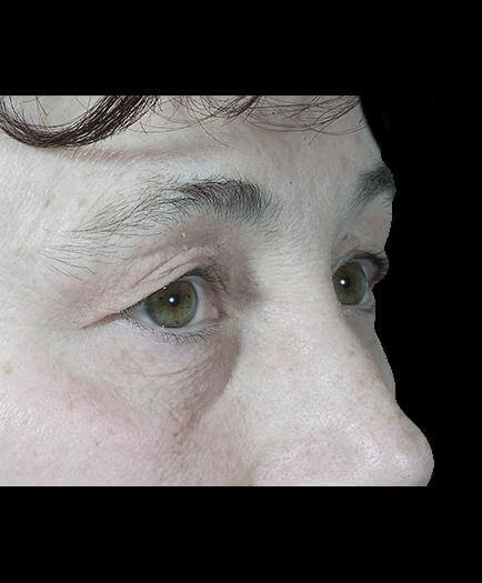 Before Blepharoplasty Right Side View