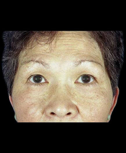 Before Virginia Blepharoplasty