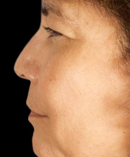 Before Rhinoplasty Side View