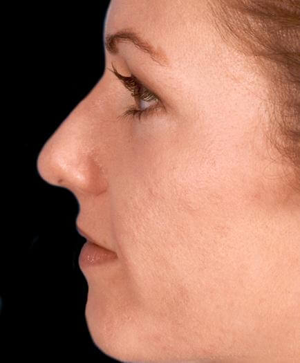 Before Rhinoplasty Surgery Side View