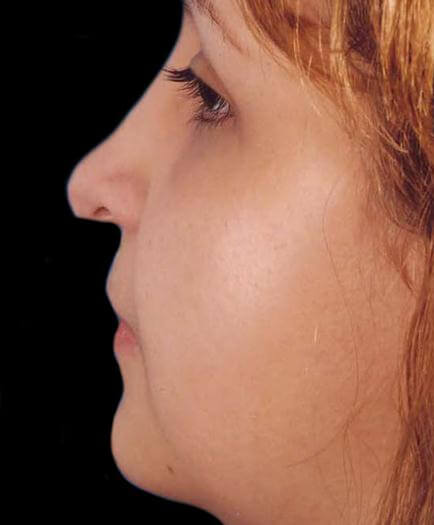 Before Nose Surgery Side View