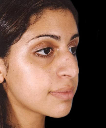 Rhinoplasty Surgery Before