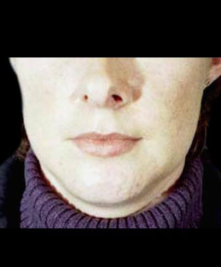 Lip Augmentation Before