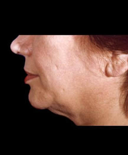 Before Neck Lift Surgery