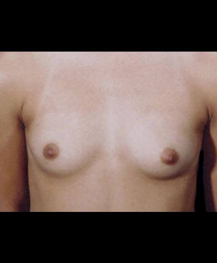 Before Breast Augmentation