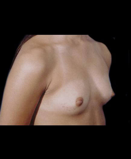 Before Breast Augmentation Right Side View